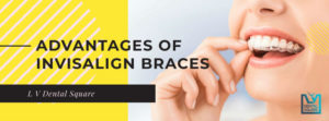 Advantages of invisaligh braces over metal braces
