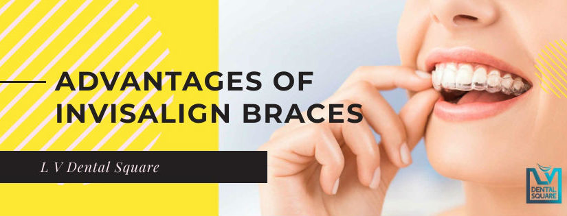 Advantages of invisaligh braces over metal braces