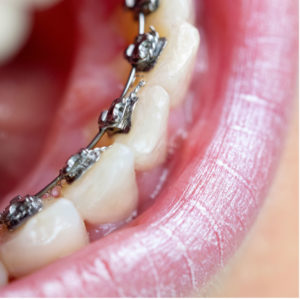 What are lingual braces