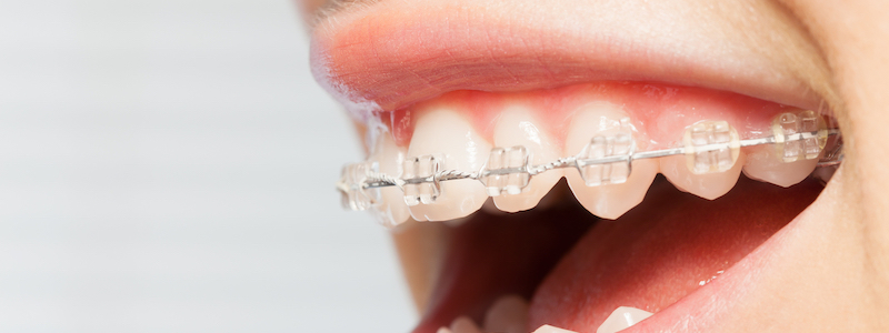 Correcting Teeth with Dental Braces : Type, Cost & Procedure in Bangalore