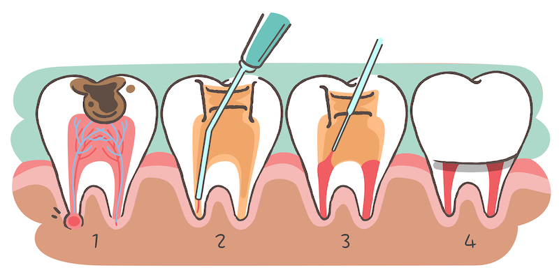 root canal treatment in bangalore