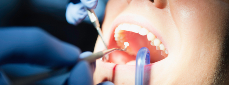 What Are Tooth Coloured Fillings?