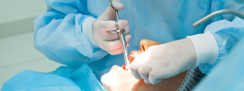 Oral surgery l v dental square bangalore
