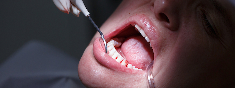 gum diseases therapy bangalore