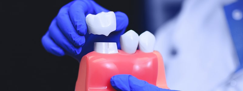 Dental crowns in bangalore L V Dental Square