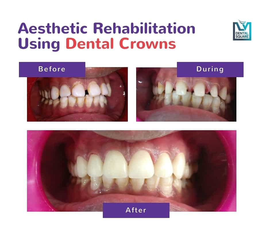 dental crowns before and after L V Dental Square bangalore