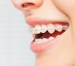 Stainless Steel Platinum Orthodontic Braces at Rs 1000/piece in Bengaluru