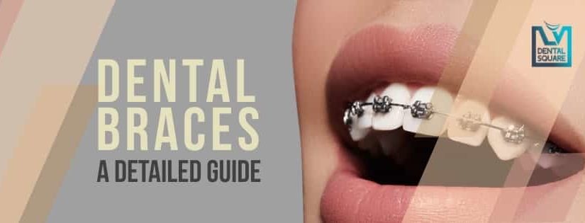 Metal Braces cost in Bangalore - Amaya Dental Clinic