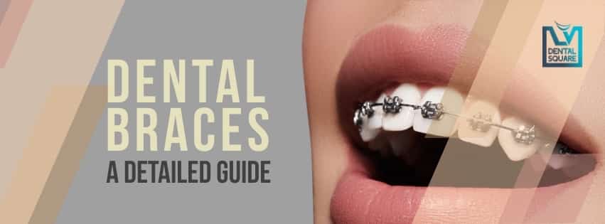 What are dental braces? : A Complete Guide
