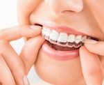 Stainless Steel Platinum Orthodontic Braces at Rs 1000/piece in Bengaluru