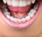 lingual dental braces