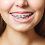 metal dental braces
