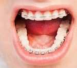 self-ligating dental braces