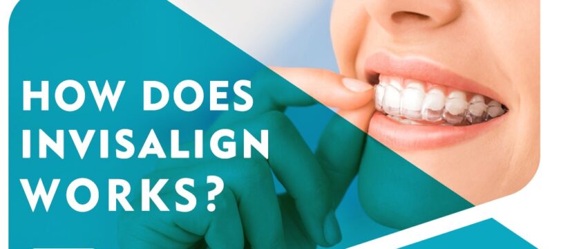 Invisalign Bangalore  Invisible Braces in Bangalore