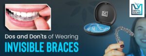 Stainless Steel Platinum Orthodontic Braces at Rs 1000/piece in Bengaluru