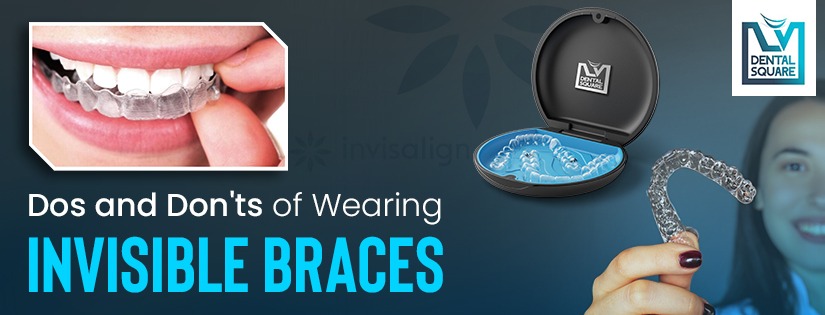 Dos and Don'ts of Wearing Invisible Braces