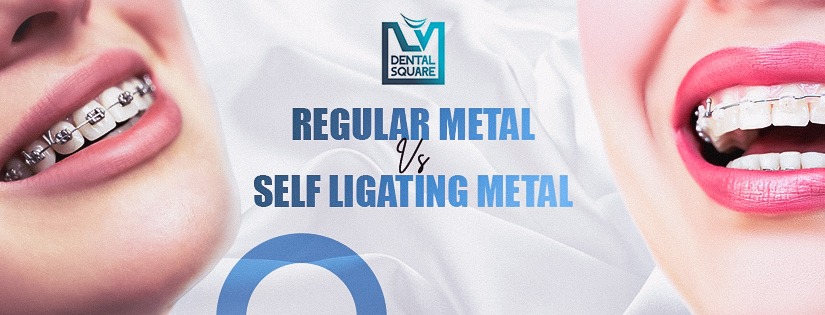 Regular Metal vs Self Ligating Metal